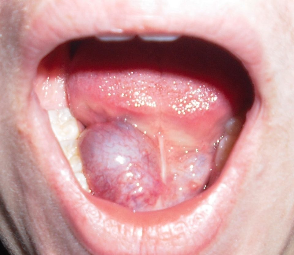 Infections des glandes salivaires